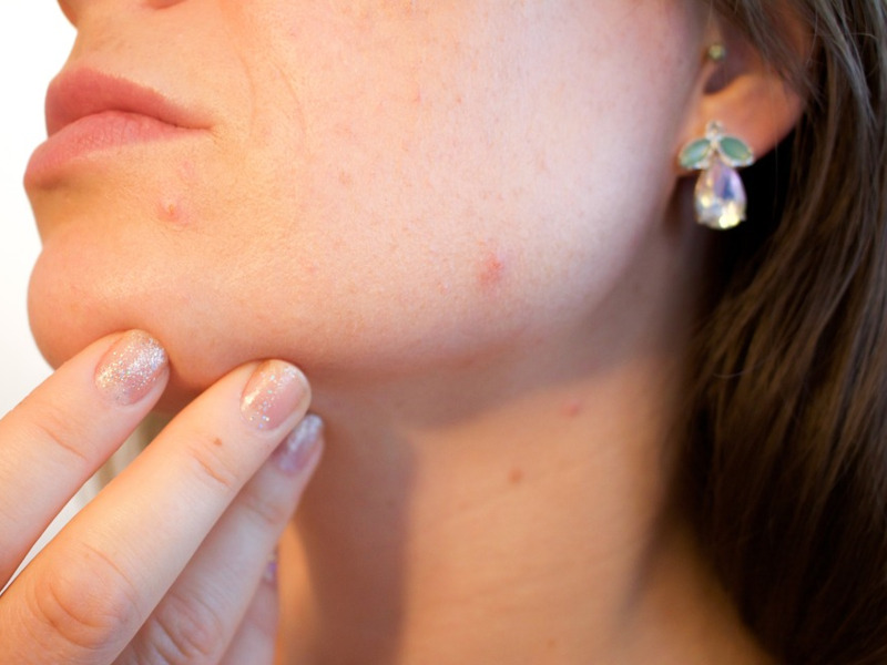 Acne in adolescenza